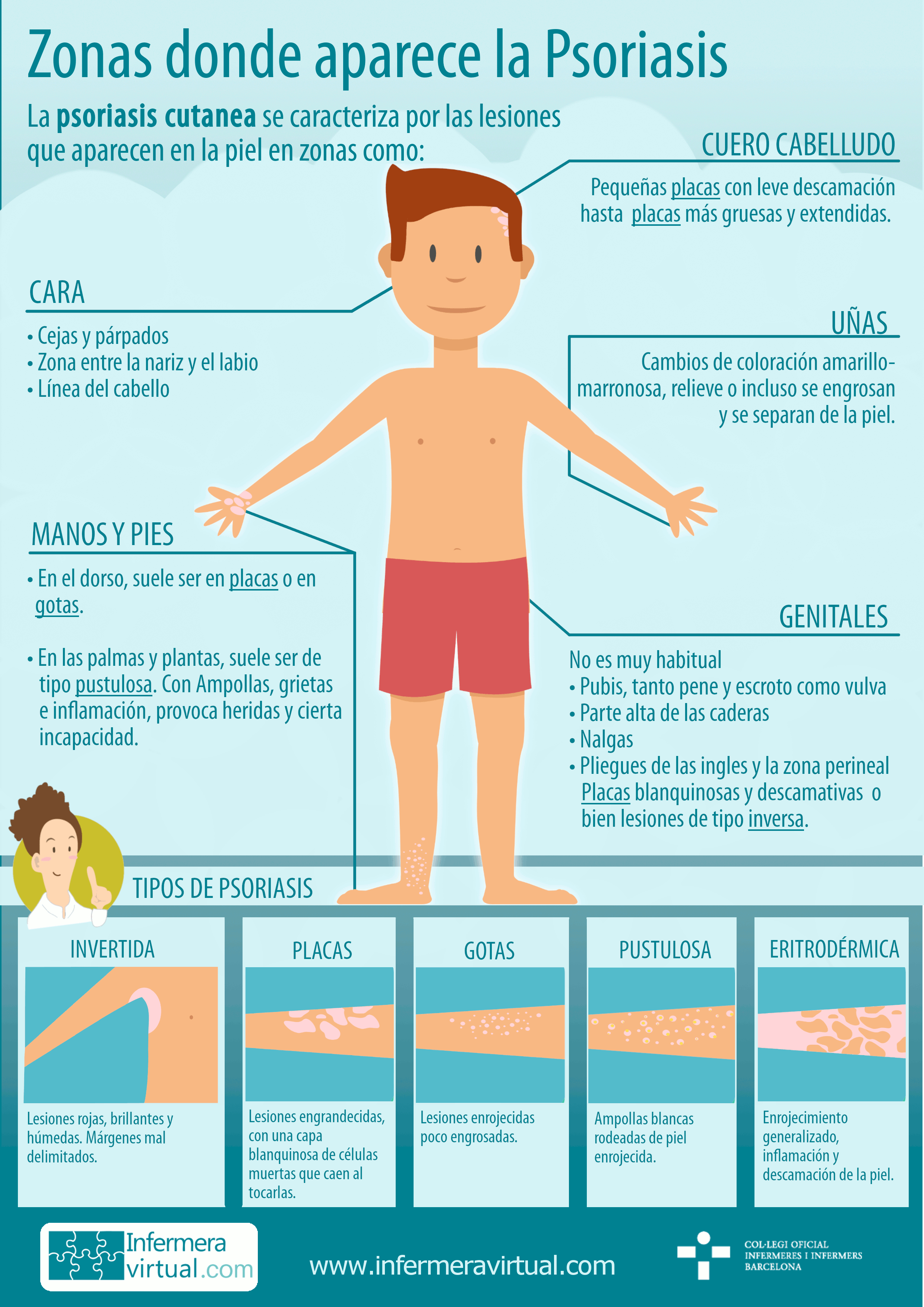Infografia Zonas Psoriasis
