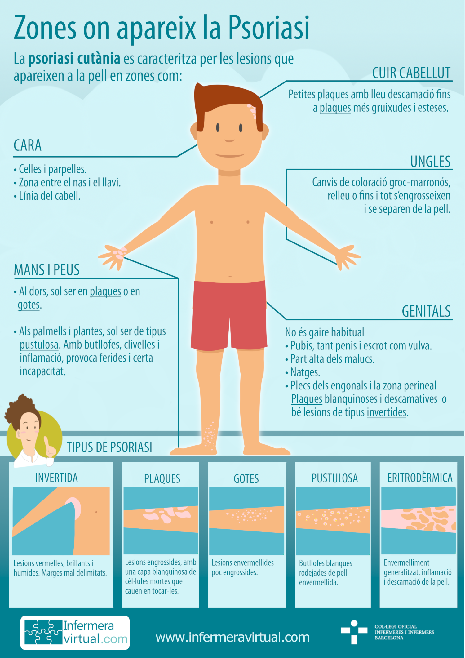 Infografia Zones Psoriasi