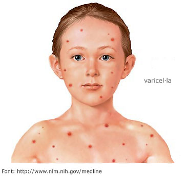 Nen amb símptomes de varicel·la