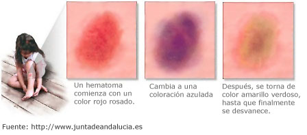 Diferentes fases de un hematoma