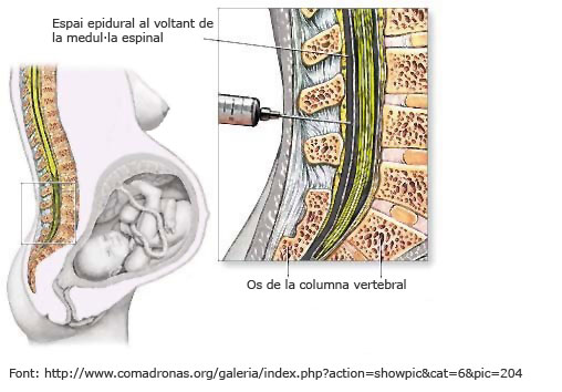 Espai epidural al voltant de la medul·la espinal