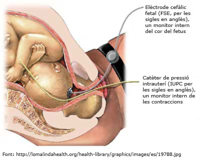 Registre cardiotocogràfic intern