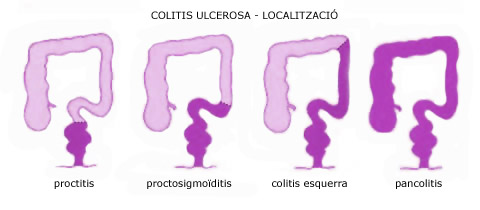 Colitis ulcerosa - localització