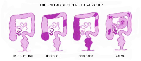 enfermedad de crohn