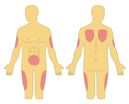 zonas de inyección subcutánea: parte superior brazos, alrededor ombligo, parte superior lateral muslos, parte superior espalda