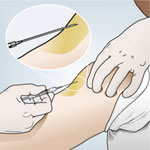 zona injecció: part superior braç
