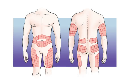 zones d'injecció: part superior braç, part anterior i lateral cuixes, part superior natja i abdomen