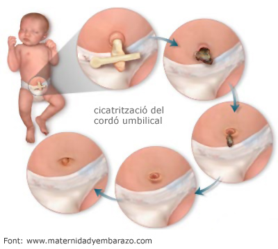 Stages of care of the umbilical cord