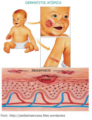 Dermatitis atòpica