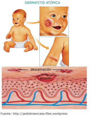 Dermatitis atópica y zonas de erosión