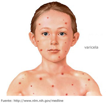 Niño con los síntomas de varicela