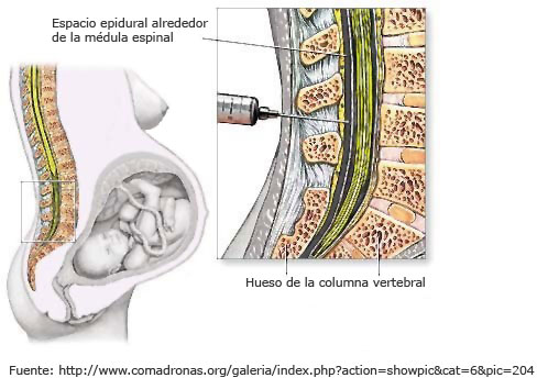 Espacio epidural alrededor de la médula espinal