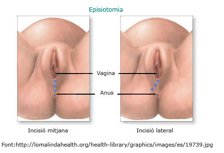 Imatge d'una episiotomia. Web Infermera Virtual
