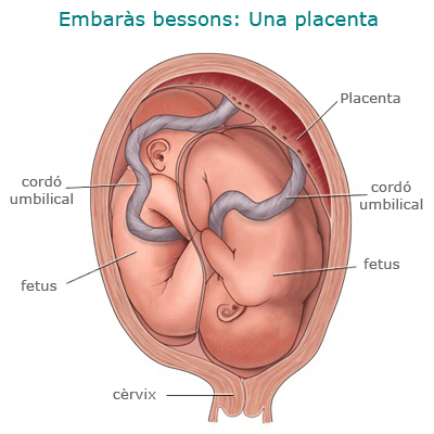 Embaràs bessons en una placenta