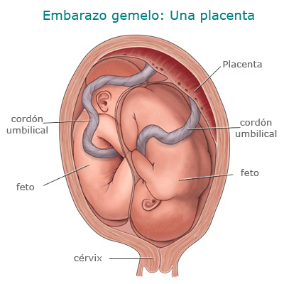 Gemelos en un sola placenta