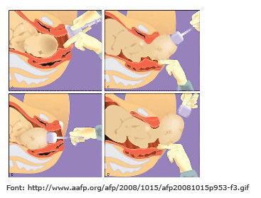 Image of baby extraction with suction cup.