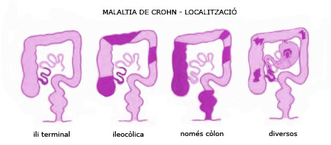 Malaltia de crohn - Localització