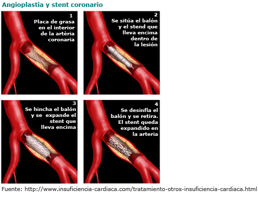 pasos de una Angioplastia