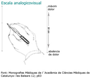 Escala analogicovisual: mà amb un bolígraf per fer un gràfic del dolor sobre un paper